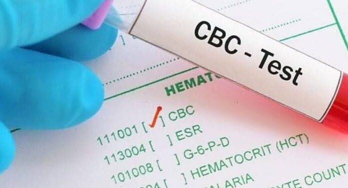 Signs You Require a CBC Test
